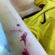 A 12-year-old boy who was attacked by a dog